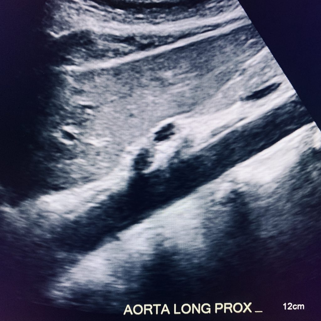 Aorta AAA (Abdominal Aorta Aneurysm) Screening