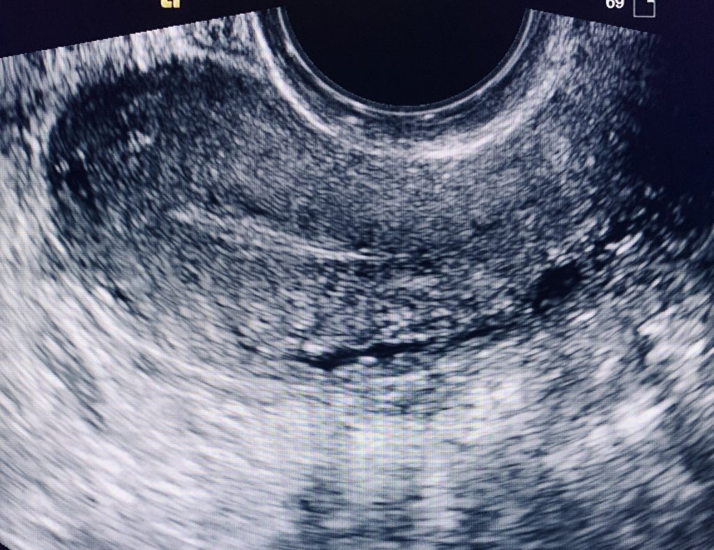 Transabdominal and Trasvaginal Pelvic Ultrasound