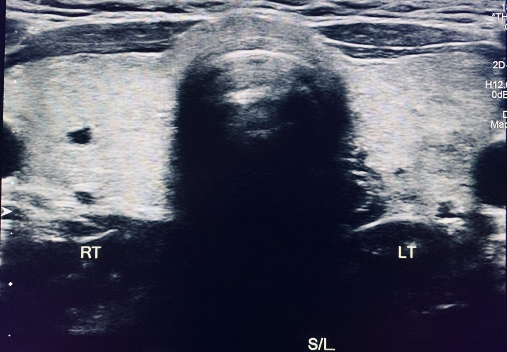Thyroid Ultrasound