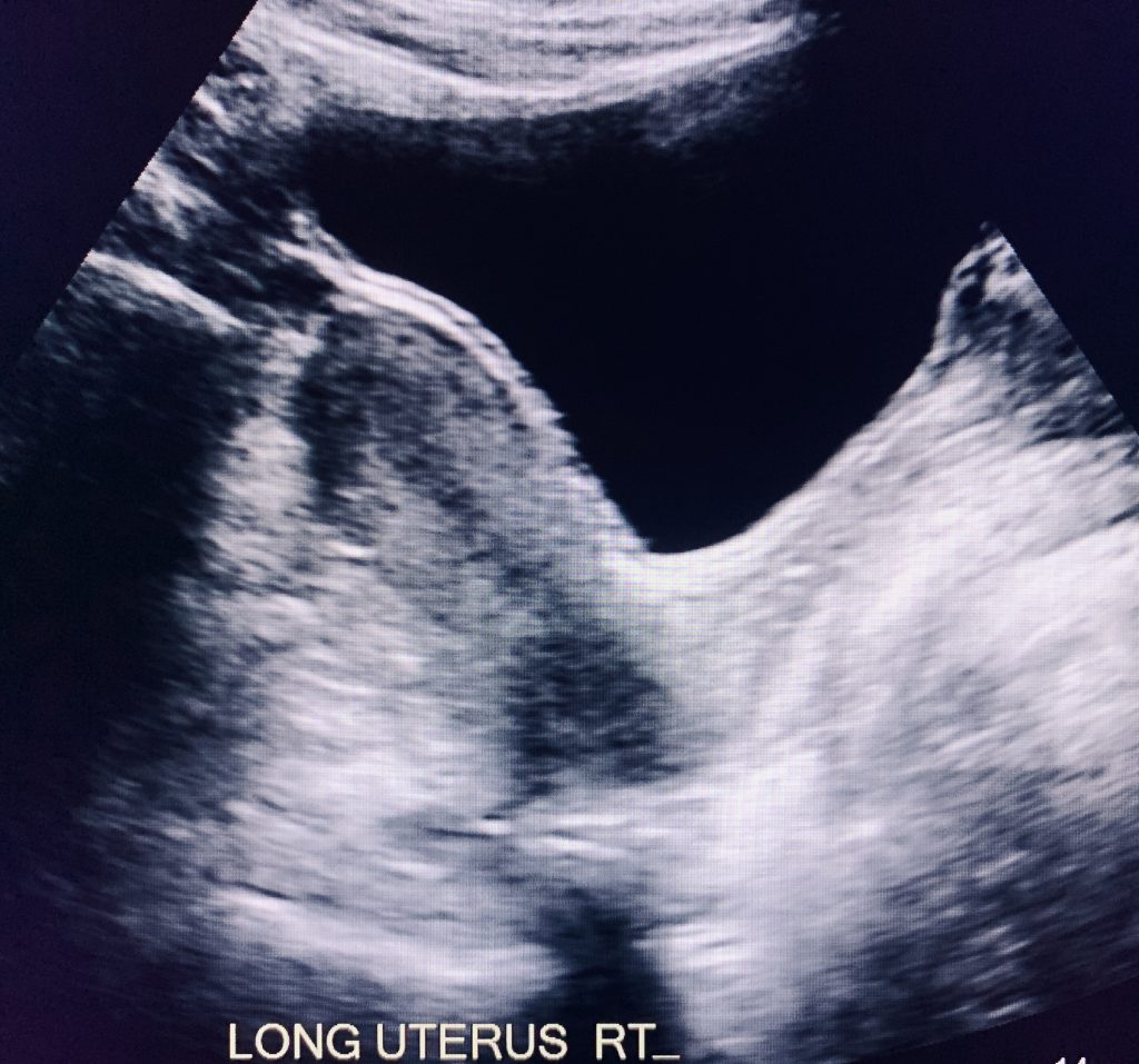 Transabdominal and Trasvaginal Pelvic Ultrasound