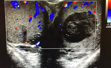Scrotal and Testis Ultrasound