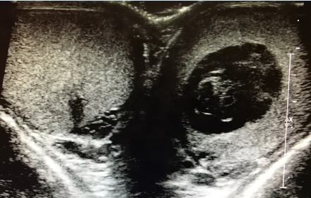 Scrotal and Testis Ultrasound