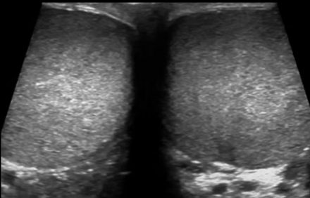 Scrotal and Testis Ultrasound