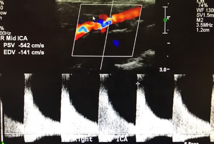 Carotid Duplex