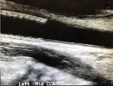 Carotid Duplex