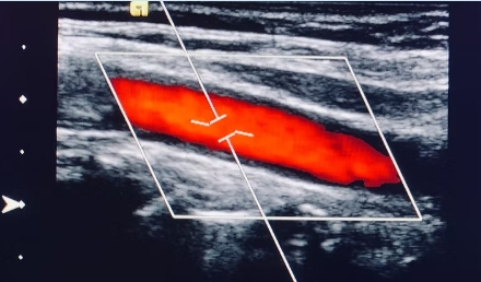 Carotid Duplex