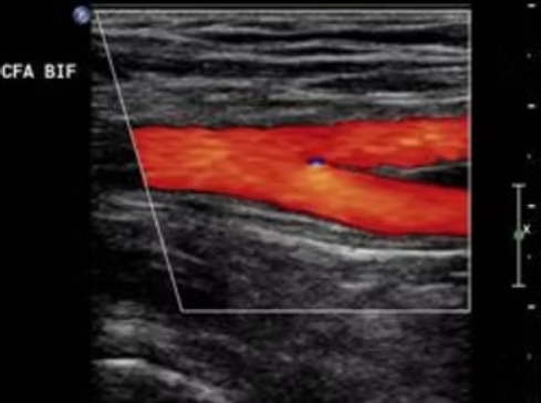 Arterial Duplex