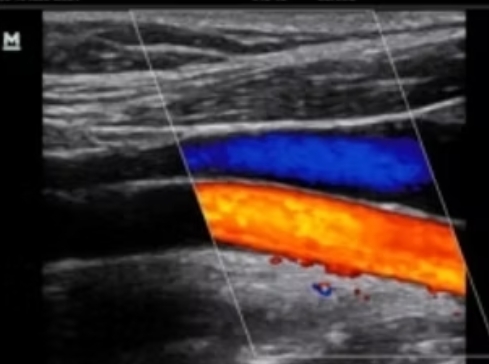 Arterial Duplex