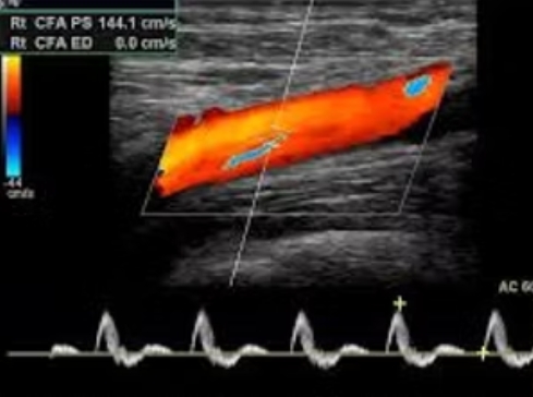Arterial Duplex