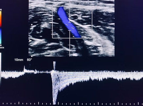 Venous Duplex