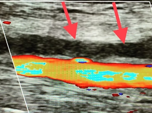 Venous Duplex