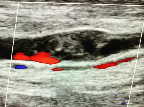 Venous Duplex