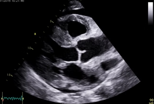 Echocardiogram