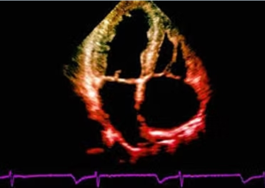 Echocardiogram