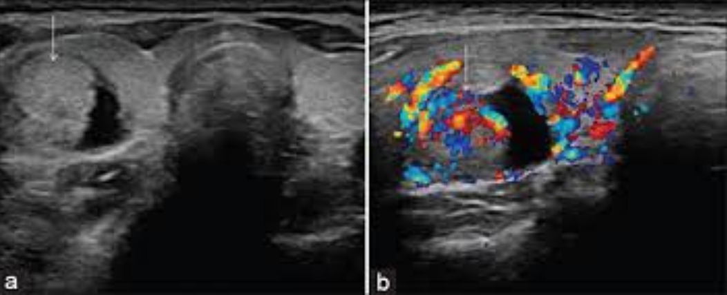 Thyroid Ultrasound