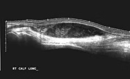 Soft Tissue Neck or Extremity